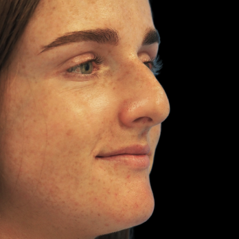 ultrasonic-rhinoplasty-before